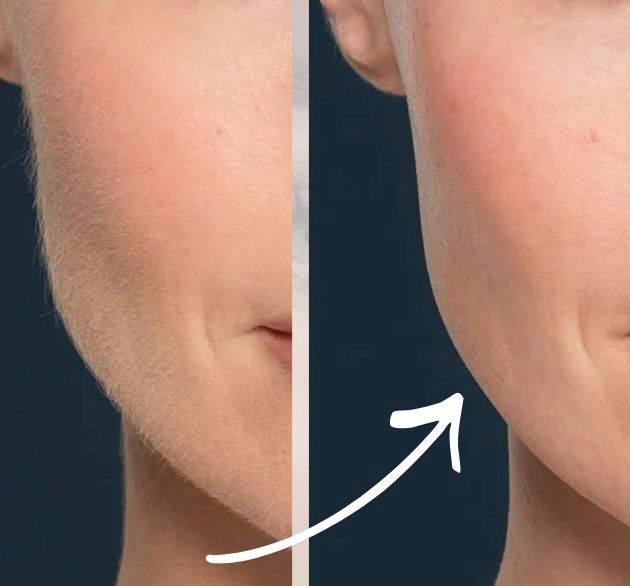 kundin mit Gesichtshaarentfernung